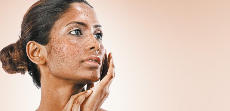 Control-of-hyper pigmentation - Cosmelan Skin Brightening Treatment, DAC Kochi