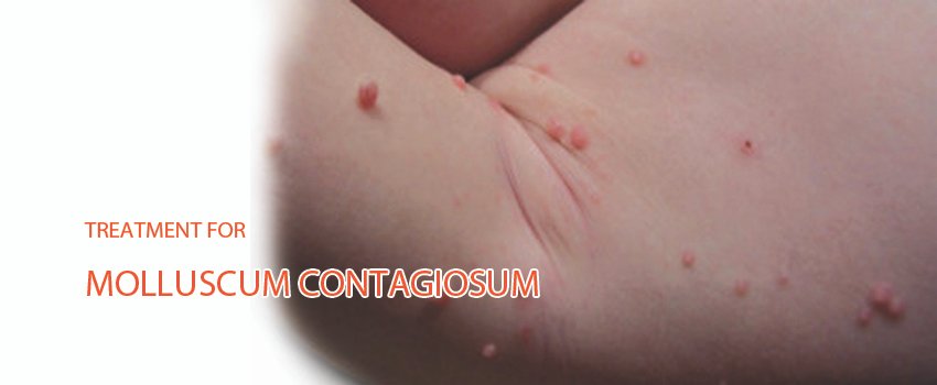 Molluscum contagiosum Treatment Skin Clinic Kochi