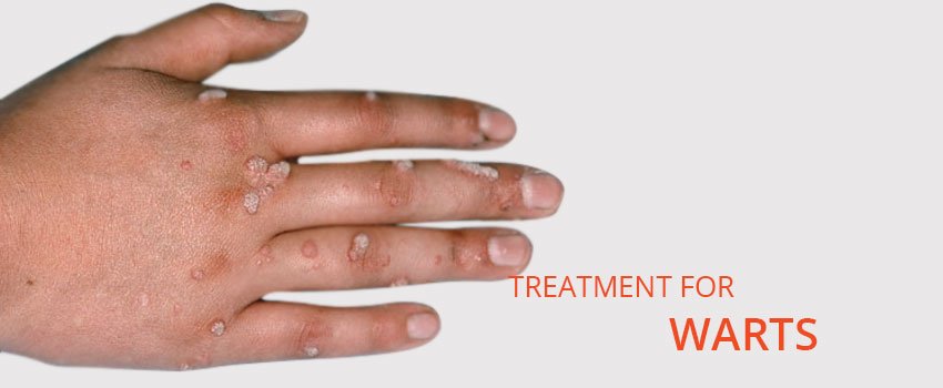 Warts Treatment Skin Clinic Kochi