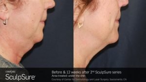 Sculpsure - Before & After