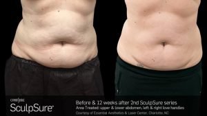 Sculpsure - Before & After