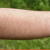 FORE-ARM-hair-removal