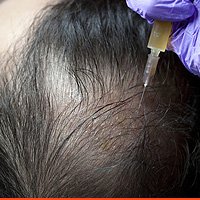 Hair Re-growth Treatment With PRFM
